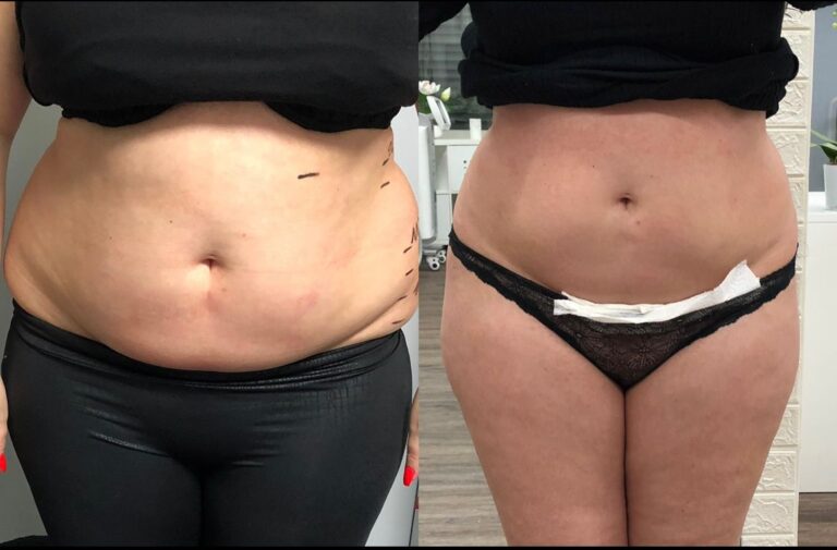 Loyalkosmetik für Fett weg mit Kryolipolyse Laser Haarentfernung, Gesichtbehandlung & Permanent Makeup Loyalkosmetik für Fett weg mit Kryolipolyse Laser Haarentfernung, Gesichtbehandlung & Permanent Makeup